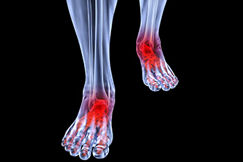 Foot and Ankle Arthritis Treatment in the Los Angeles, CA 90033, Huntington Park, CA 90255, Reseda, CA 91335 areas
