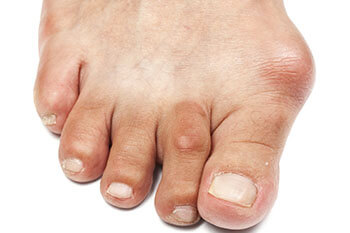 Minimally Invasive Bunion Surgery in the Los Angeles County, CA: Los Angeles (Long Beach, Glendale, Torrance, Pasadena, Santa Monica), Huntington Park (Downey, Norwalk, Compton, lynwood) & Reseda (Santa Clarita, Thousand Oaks, Burbank) areas