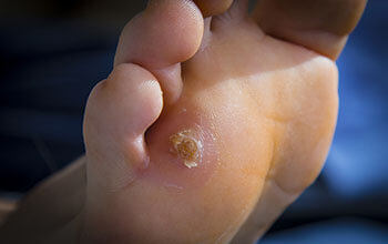 Corns & Calluses Treatment in the Los Angeles County, CA: Los Angeles (Long Beach, Glendale, Torrance, Pasadena, Santa Monica), Huntington Park (Downey, Norwalk, Compton, lynwood) & Reseda (Santa Clarita, Thousand Oaks, Burbank) areas