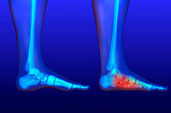 Flat feet and Fallen Arches treatment in the Los Angeles County, CA: Los Angeles (Long Beach, Glendale, Torrance, Pasadena, Santa Monica), Huntington Park (Downey, Norwalk, Compton, lynwood) & Reseda (Santa Clarita, Thousand Oaks, Burbank) areas