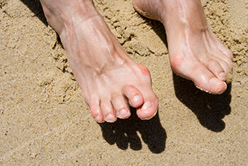 Hammertoe & Mallet Toe Treatment in the Los Angeles County, CA: Los Angeles (Long Beach, Glendale, Torrance, Pasadena, Santa Monica), Huntington Park (Downey, Norwalk, Compton, lynwood) & Reseda (Santa Clarita, Thousand Oaks, Burbank) areas