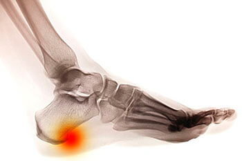 Heel Spur Specialist in the Los Angeles County, CA: Los Angeles (Long Beach, Glendale, Torrance, Pasadena, Santa Monica), Huntington Park (Downey, Norwalk, Compton, lynwood) & Reseda (Santa Clarita, Thousand Oaks, Burbank) areas