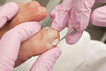 Ingrown Toenails Diagnosis & Treatment in the Los Angeles County, CA: Los Angeles (Long Beach, Glendale, Torrance, Pasadena, Santa Monica), Huntington Park (Downey, Norwalk, Compton, lynwood) & Reseda (Santa Clarita, Thousand Oaks, Burbank) areas