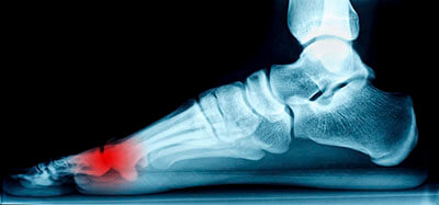 Morton's Neuroma Treatment in the Los Angeles County, CA: Los Angeles (Long Beach, Glendale, Torrance, Pasadena, Santa Monica), Huntington Park (Downey, Norwalk, Compton, lynwood) & Reseda (Santa Clarita, Thousand Oaks, Burbank) areas