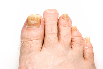 Toenail Fungus Diagnosis & Treatment in Los Angeles County, CA: Los Angeles (Long Beach, Glendale, Torrance, Pasadena, Santa Monica), Huntington Park (Downey, Norwalk, Compton, lynwood) & Reseda (Santa Clarita, Thousand Oaks, Burbank) areas