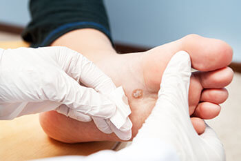 Plantar Warts Care & Treatment in the Los Angeles County, CA: Los Angeles (Long Beach, Glendale, Torrance, Pasadena, Santa Monica), Huntington Park (Downey, Norwalk, Compton, lynwood) & Reseda (Santa Clarita, Thousand Oaks, Burbank) areas