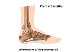 Do I Have Plantar Fasciitis?