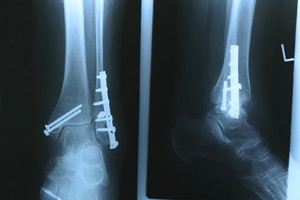 What Are the Different Types of Fractures?