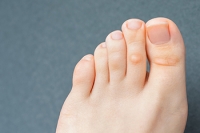 What to Do About Foot Corns