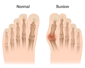 How to Treat a Bunion